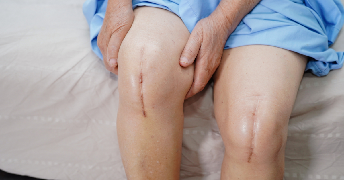 Physiotherapy After Knee Replacement Surgery - What to Expect